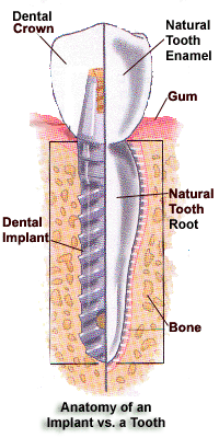 implant