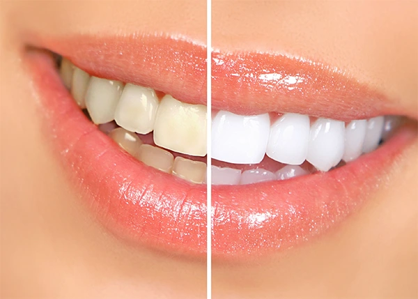 teeth-smile