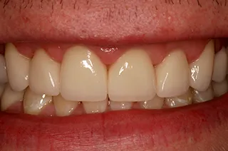 case-new-11-after