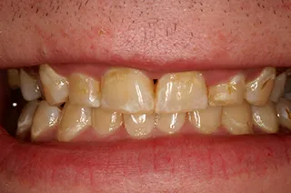 case-new-11-before