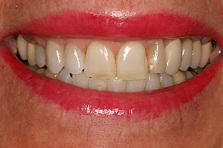 case-new-13-before
