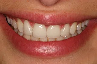case-new-14-after
