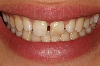 case-new-14-before