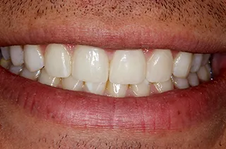 case-new-15-after