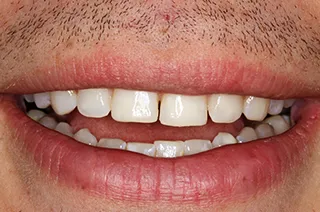 case-new-15-before