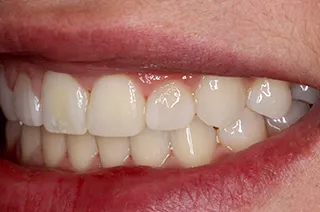 case-new-16-after