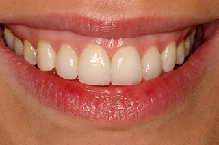 case-new-17-after