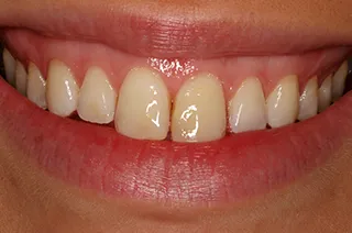 case-new-17-before