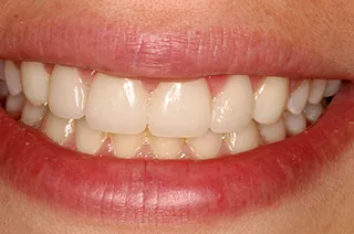 case-new-18-after