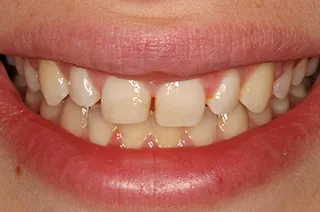 case-new-18-before