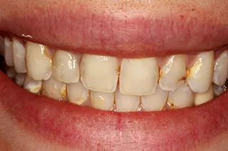 case-new-20-before