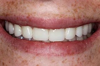 case-new-21-after