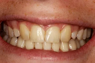 case-new-21-before